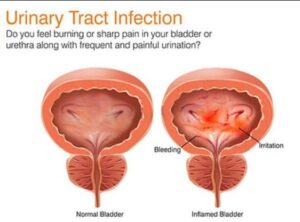UTI Treatment in Pune